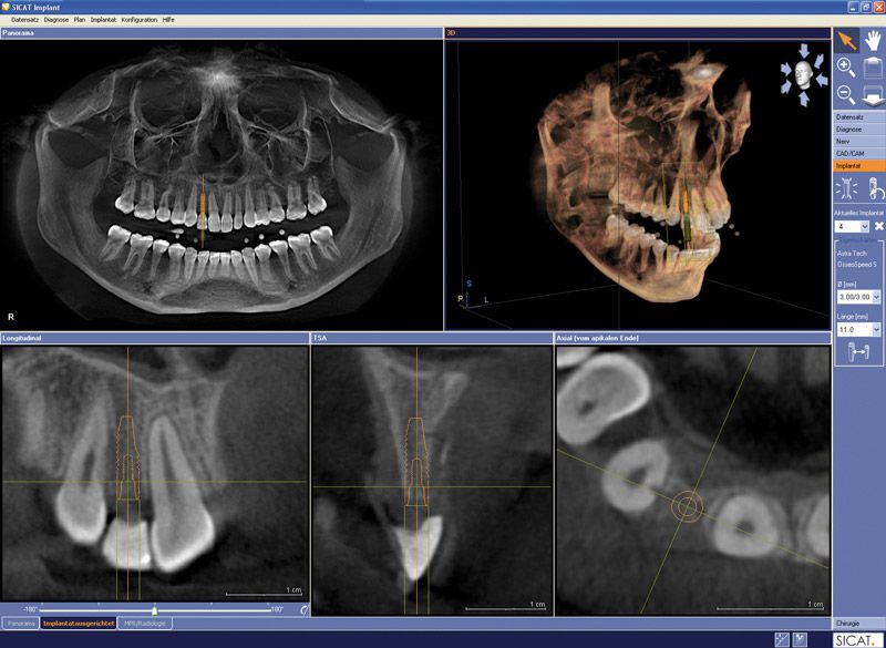3D-Implantatplanung